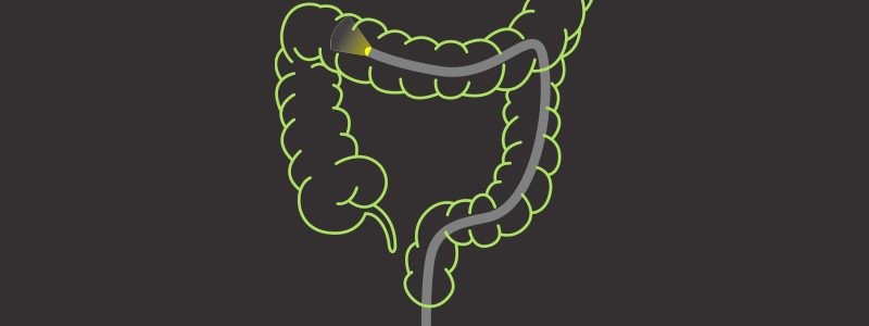 Colonoscopy: What’s the Right Age to Begin?
