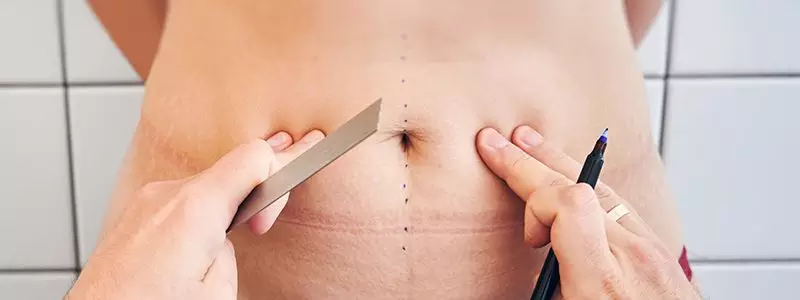 Preoperative Patient Preparation