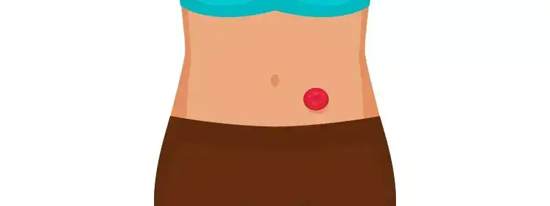 Why Is a Stoma (Colostomy or Ileostomy) Necessary?